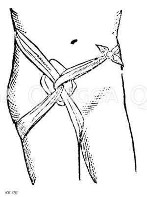 Leistenverband [Digital]