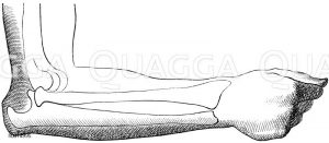 Mensch: Verrenktes Ellenbogengelenk [Digital]