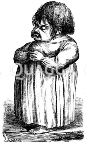 Erwachsener Kretin (nach Virchow) [Digital]