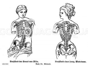 Brustkorb der Venus von Milo (links) und Brustkorb einer französischen Modedame (rechts), Schädigungen durch das Tragen eines Korsetts. Nach Dr. Meinert [Digital]