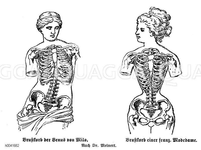 Brustkorb der Venus von Milo (links) und Brustkorb einer französischen Modedame (rechts), Schädigungen durch das Tragen eines Korsetts. Nach Dr. Meinert [Digital]