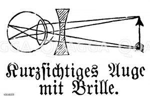 Kurzsichtiges Auge mit Brille [Digital]