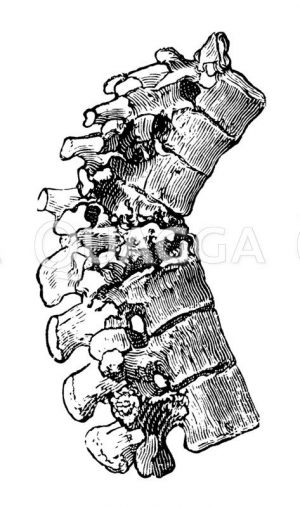 Tuberkulose der Wirbelsäule Zeichnung/Illustration