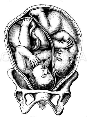 Zwillinge in Schädellage Zeichnung/Illustration