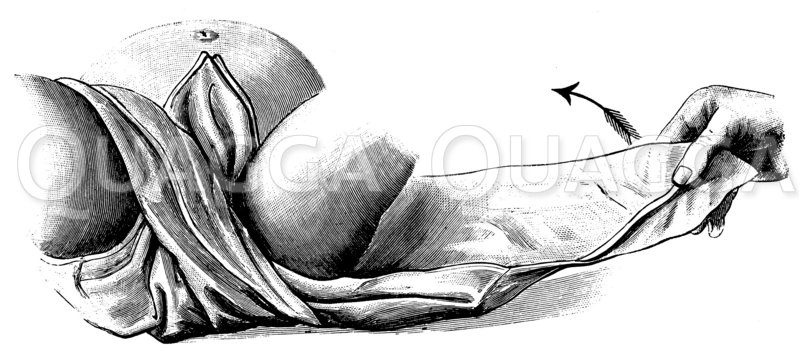 Anlegen einer Windel Zeichnung/Illustration