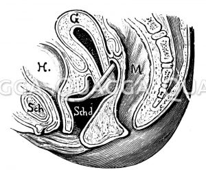 Richtige Lage des Matrisalus-Pessars
