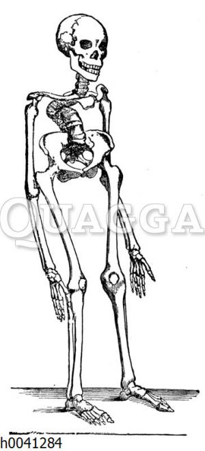 Skelett eines Rachitis-Kranken (Kyphose)