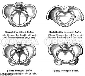 Weibliches Becken: Normal und verengte Formen