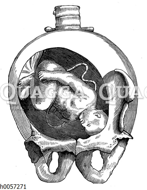 Lage eines Kindes in der Gebärmutter: Schiefe Stellung des Kopfes