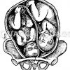 Lage von Zwillingen in der Gebärmutter: Schädellage