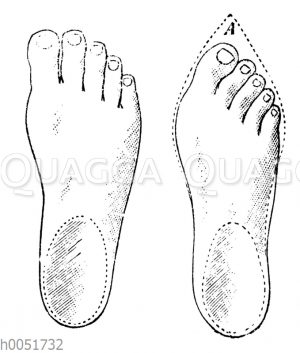 Verformung des Fußes in einem spitzen Schuh