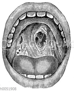 Syphilis: Durchlöcherung des harten Gaumens