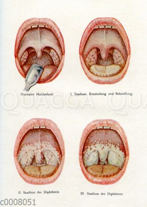 Diphteriesymptome im Mund