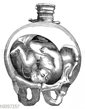 Fötus in der Gebärmutter. Gesichtslage: Die Stirn liegt auf dem Muttermund auf