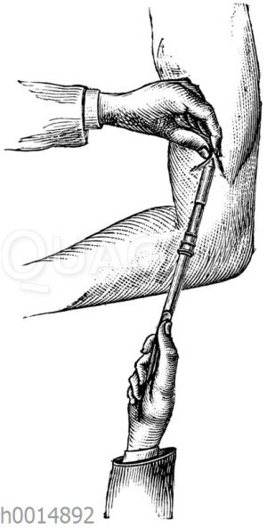 Morphiumeinspritzung unter die Haut mit der Leiterschen Patentspritze