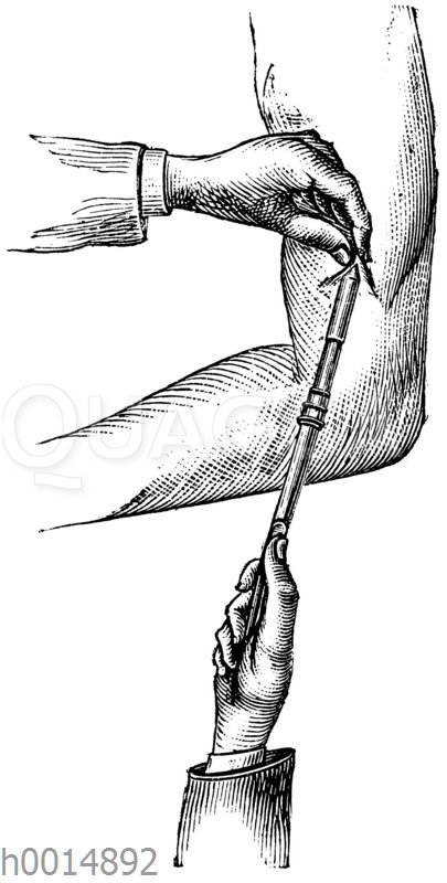 Morphiumeinspritzung unter die Haut mit der Leiterschen Patentspritze