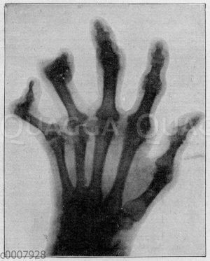 Röntgenaufnahme einer durch Gicht verunstalteten Hand