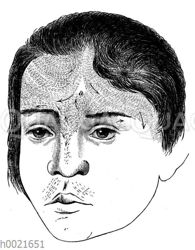 Kopf eines Mädchens mit behaarter Stirn