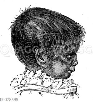 Porträt des ebenfalls an Hypertrichose leidenden Kindes der Julia Pastrana