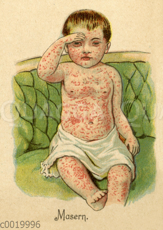 Kind mit durch Masern verursachten Hautausschlag