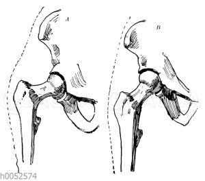 Knochenstellung zwischen Oberschenkel und Hüftbein bei breiten und schmalen Hüften